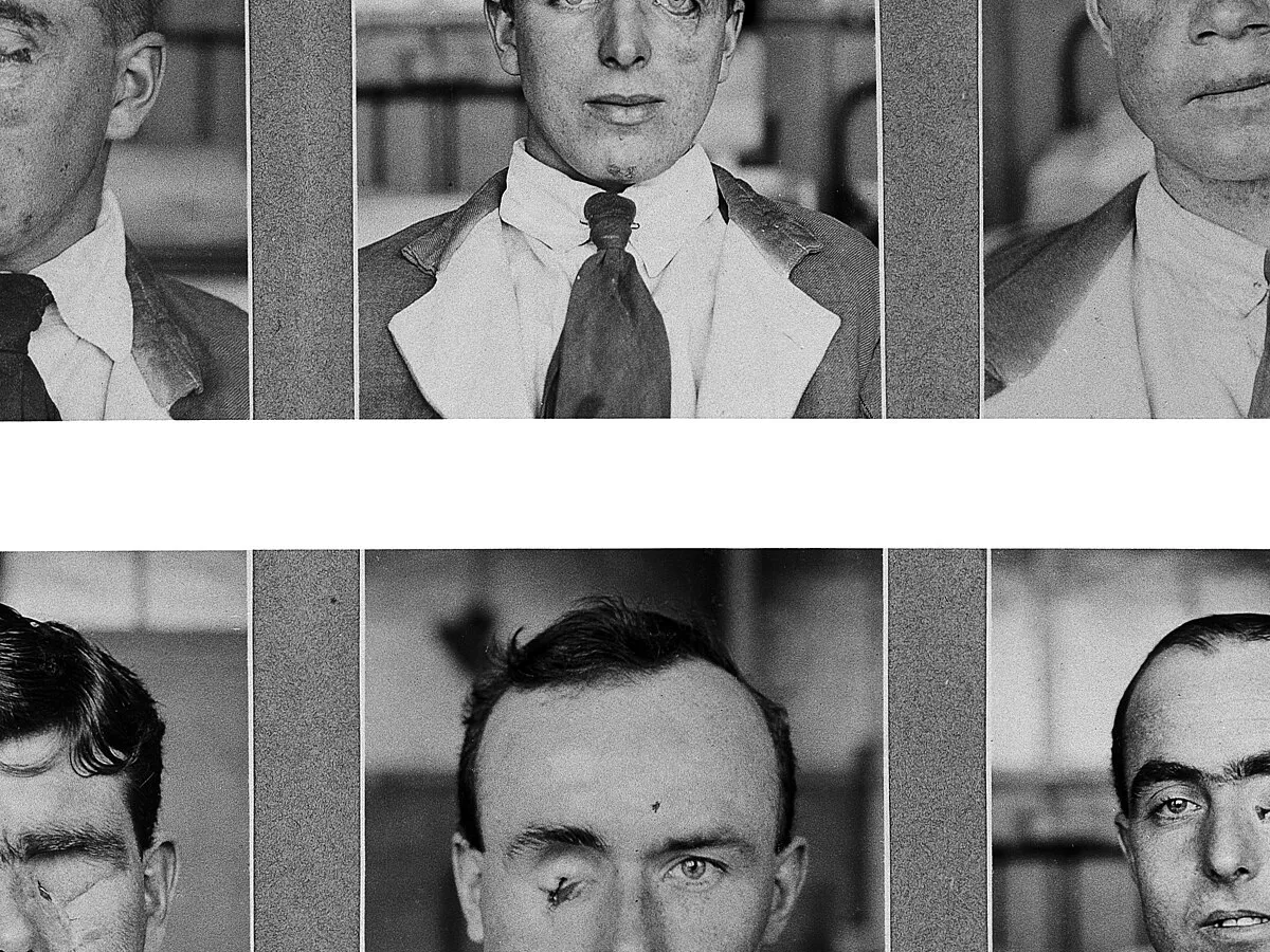 Representative image: Photographs of patients', (soldiers') recovery taken from two albums of photographs of plastic surgery cases at The King George Military Hospital, (later Red Cross Hospital), Stamford Street, London. Archives & Manuscrip